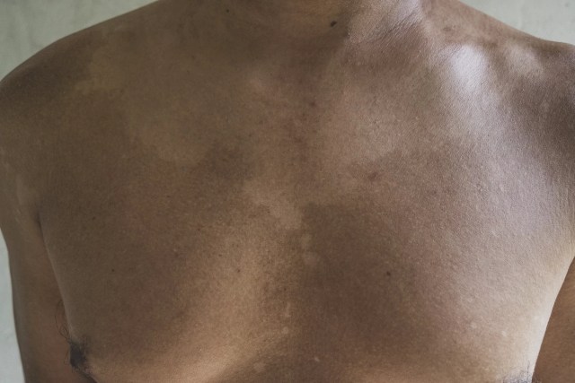 Marcas na pele de Francisco após entrar nos igarapés contaminados com agrotóxicos