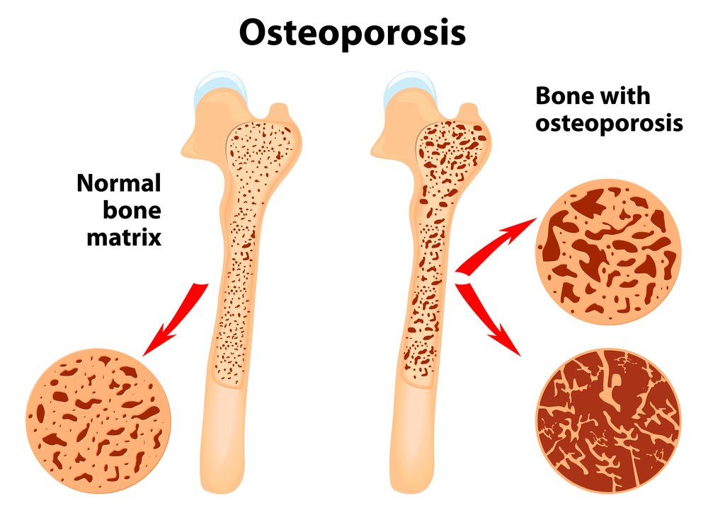 Osteonecrose osteoporose