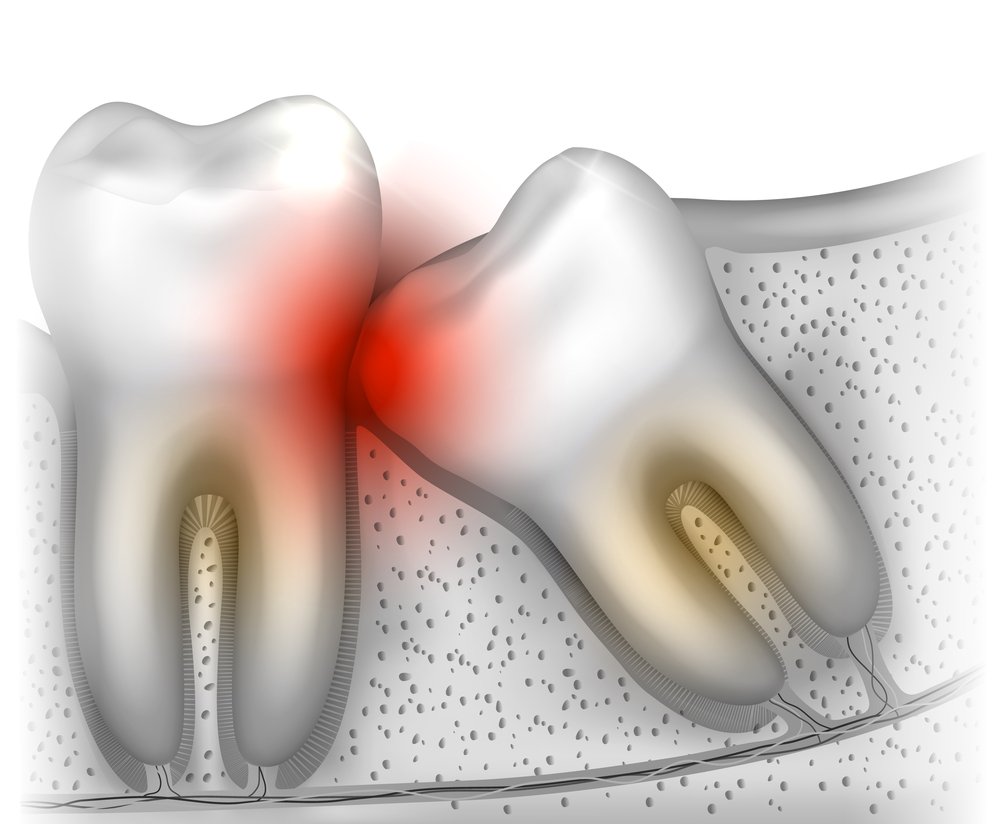 Pericoronarite dente