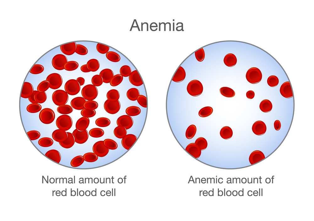 Anemia crônica