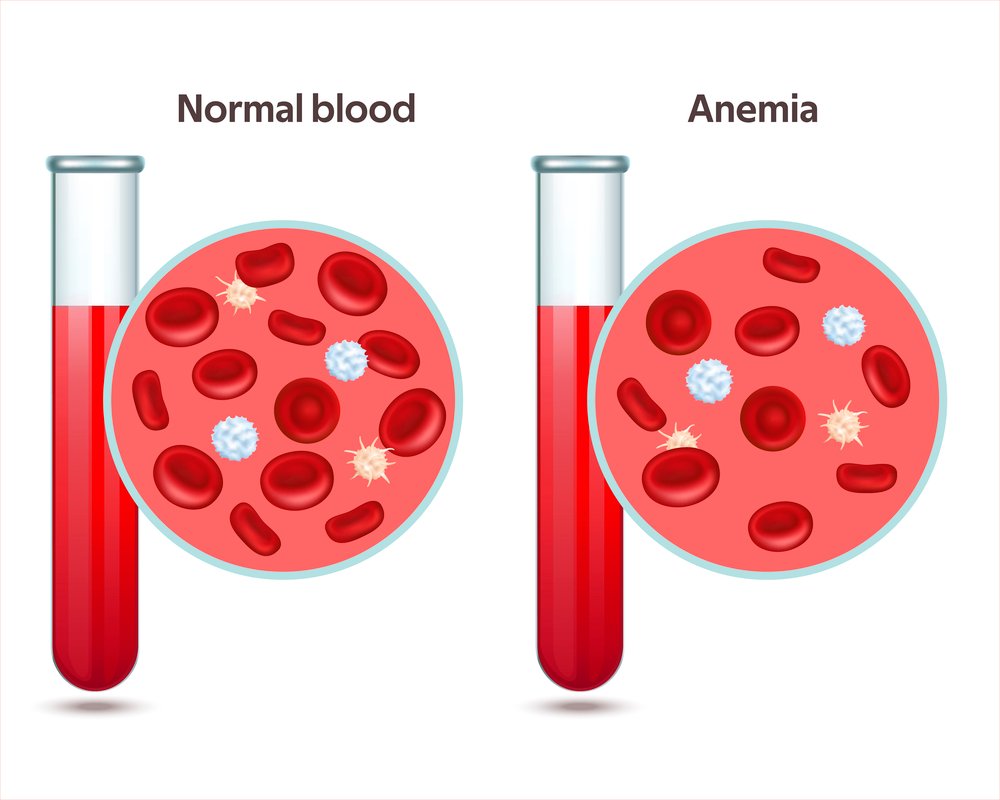 Hematocrito anemia