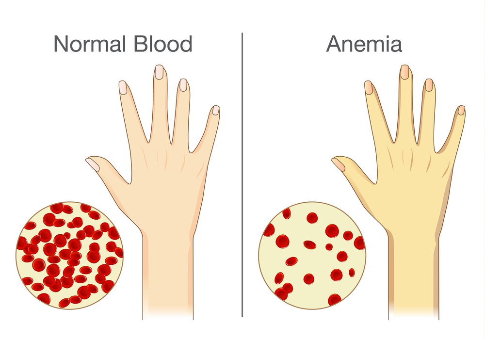 anemia pele amarelada