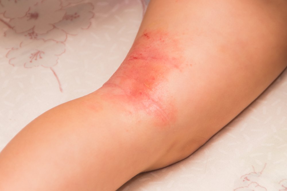 infecções fúngicas da pele
