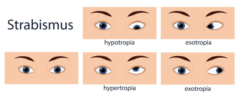 sintomas de Estrabismo infantil